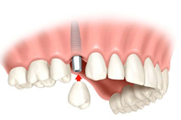 implantat Implantat namesto 4 zgoraj