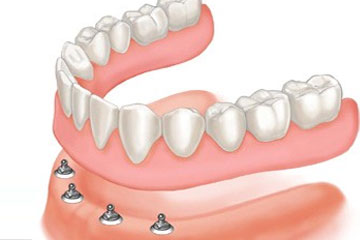 proteza-implatanti Proteza na implantatih