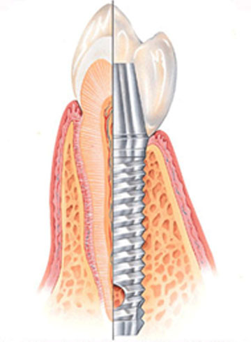 Amalgamska plomba